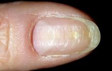 pofalowana płytka paznokcia