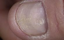 pomarszczone paznokcie
