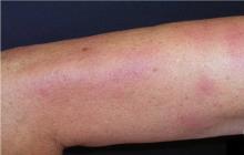 przewlekłe zanikowe zapalenie skóry kończyn choroba borelioza