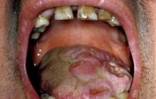 syfilis choroba jama ustna