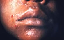 syphilitic on the face