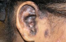 toczeń postać odmrozinowa ucho