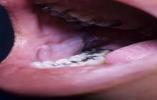 toczeń rumieniowaty jamy ustnej
