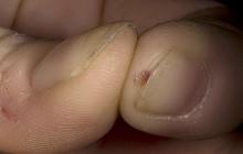 twardziny skóry palców