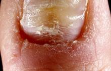 wgniecenia na paznokciach