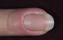 zanokcica przewlekła paznokcia