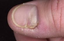 zanokcica przewlekła paznokcia kciuk