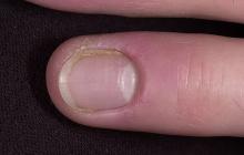 zanokcica przewlekła paznokcia palec