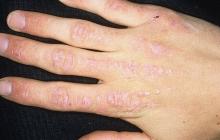 zapalenie skórno-mięśniowe ręki palcy
