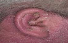 zapalenie skóry ucha jak leczyć