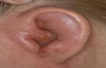 zapalenie ucha u dorosłych objawy