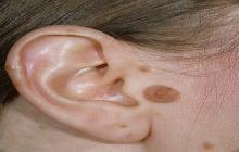 znamiona melanocytowe barwnikowe ucho