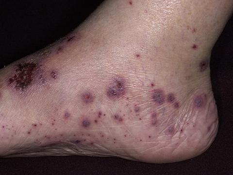 alergiczne zapalenie naczyń stopa