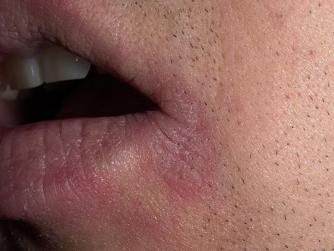 atopowe zapalenie skóry kąciki ust