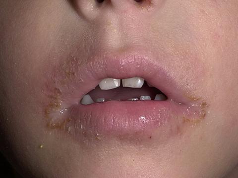 atopowe zapalenie skóry w kącikach ust