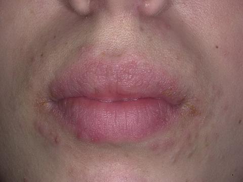 atopowe zapalenie skóry wokół ust