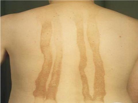 berloque dermatitis na plecach