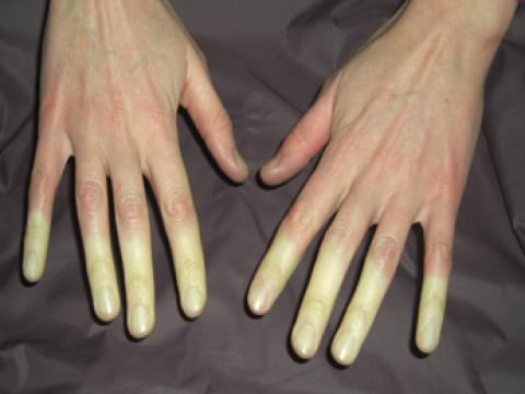 białe palce