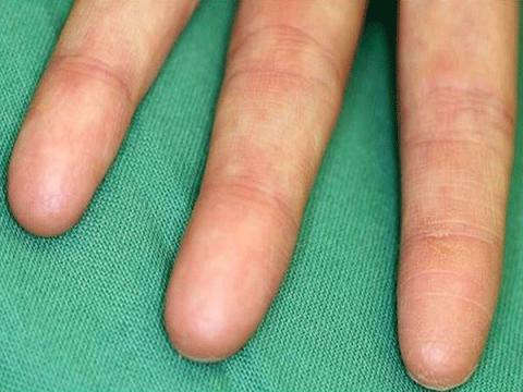 brak odcisków palców - adermatoglyphia