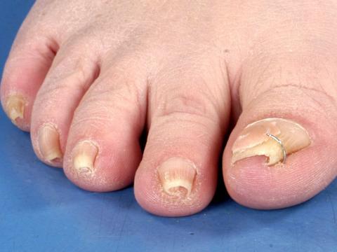 choroby paznokci u nóg zdjęcia