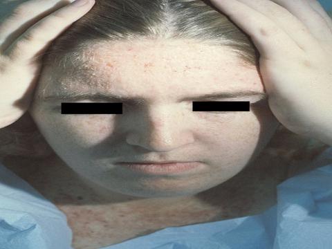 dariera choroba wypryski na twarzy kobieta