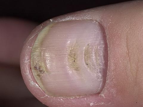 deformacja paznokcia kciuka