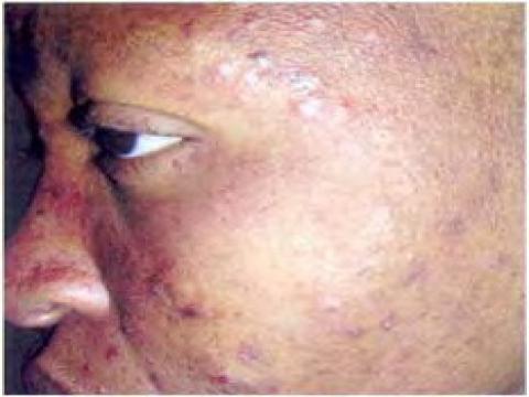 eozynofilowe zapalenie mieszków włosowych na twarzy