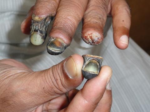 gangrena palca dłoni objawy