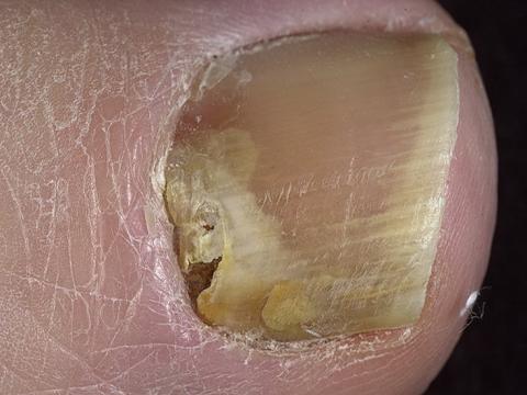 grzybica paznokci leczenie