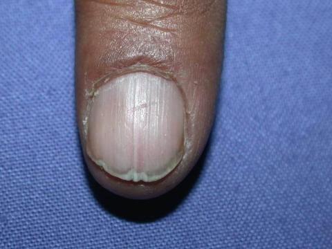  łamliwości płytki paznokciowej (onychorrhexis)