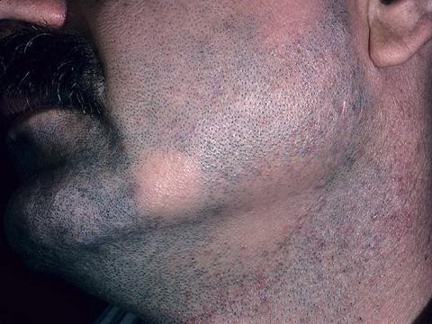 łysienie plackowate na brodzie