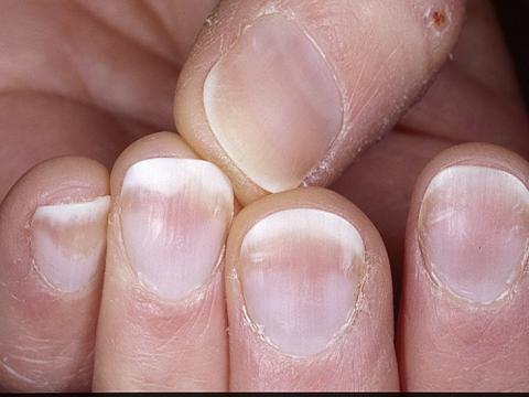 odwarstwianie paznokci palcy
