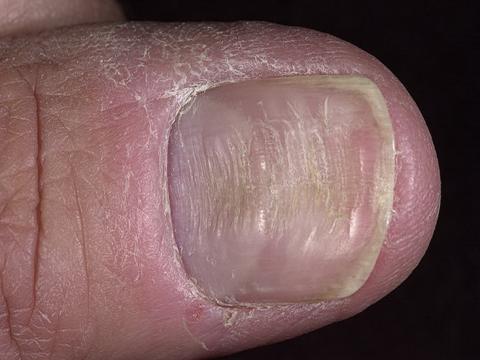 paznokcie choroby bruzdy podłużne