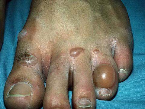 pęcherzyca stopa palce