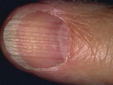 podłużne wyżłobienia na paznokciach (onychorrhexis)