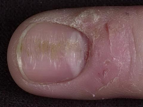 pofałdowane paznokcie przyczyny