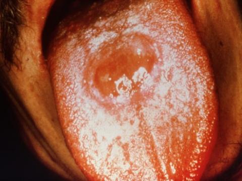 syfilis choroba język