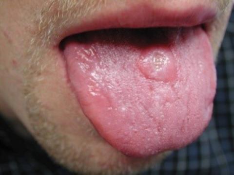syfilis choroba na języku