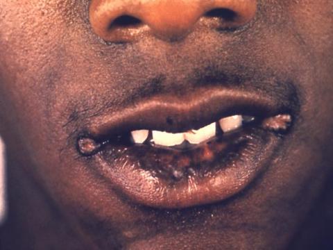 syphilis mouth