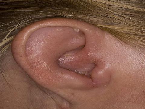 ucho zapalenie