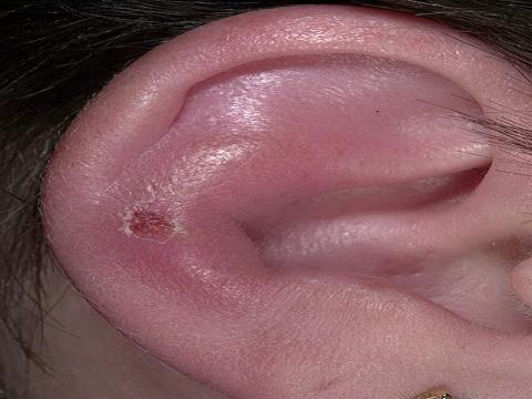 zapalenie ucha objawy dorosli