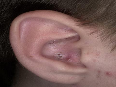 zaskórniki otwarte w uchu