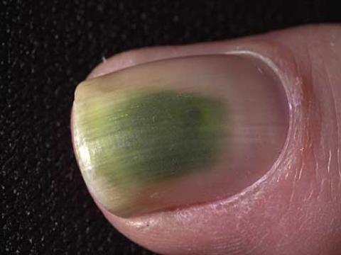zielone paznokcie choroba